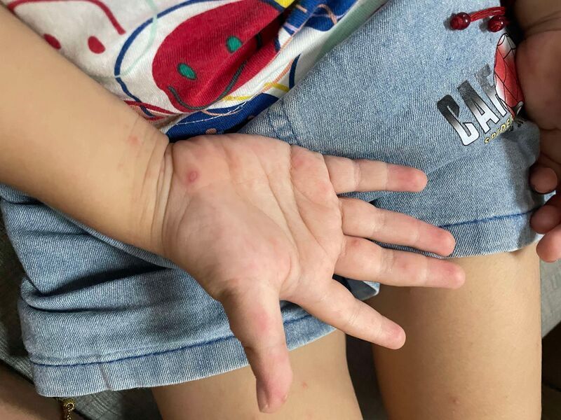 El número de infectados por enterovirus alcanza un nuevo récord en los últimos cinco años